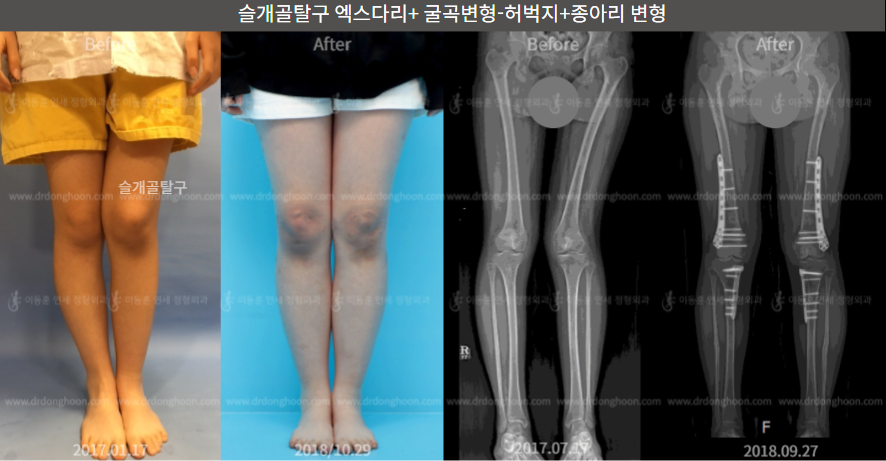 슬개골탈구 엑스다리 + 굴곡변형-허벅지+종아리 변형