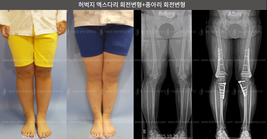 허벅지 엑스다리 회전변형+종아리 회전변형