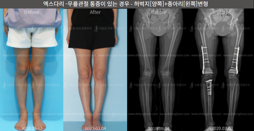 엑스다리 - 무릎관절 통증이 있는 경우 - 허벅지[양쪽]+종아리[왼쪽] 변형