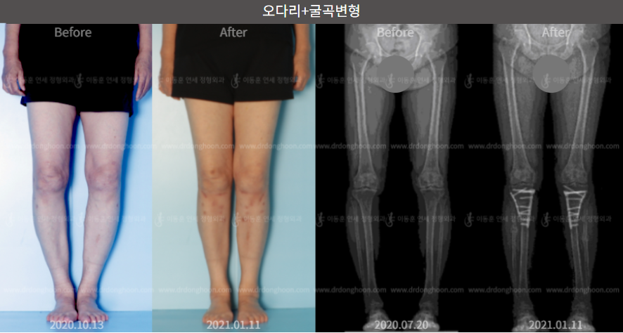 오다리+굴곡변형