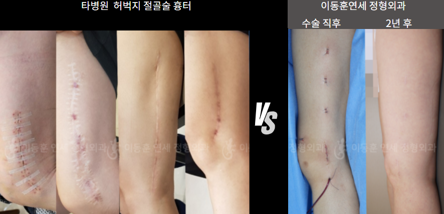 타병원 허벅지 절골술 흉터 vs 이동훈연세 정형외과