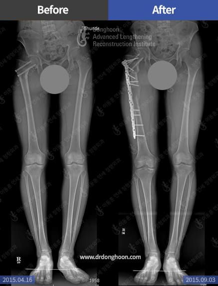 leg length discrepancy and coxa vara deformity- treated by femoral lengthening(LOP) and correctional osteotomy