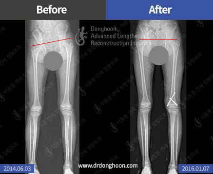 Pediatric Leg Length Discrepancy – Epiphysiodesis X-ray