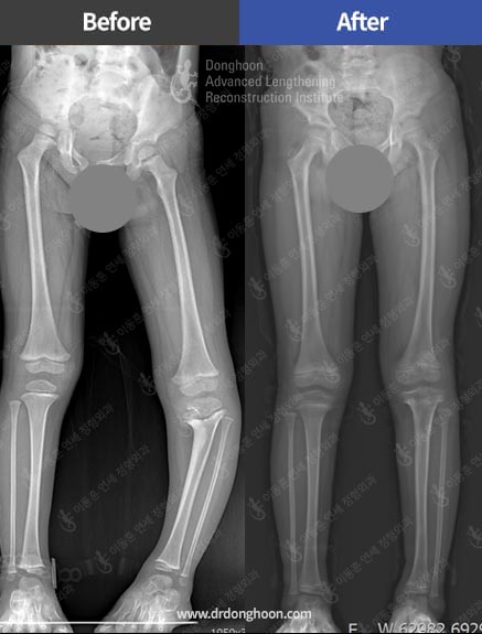 블라운트 병(Blount disease)으로 인한 하지부동 및 오다리를 치료