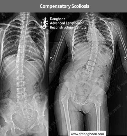 Compensatory Scoliosis