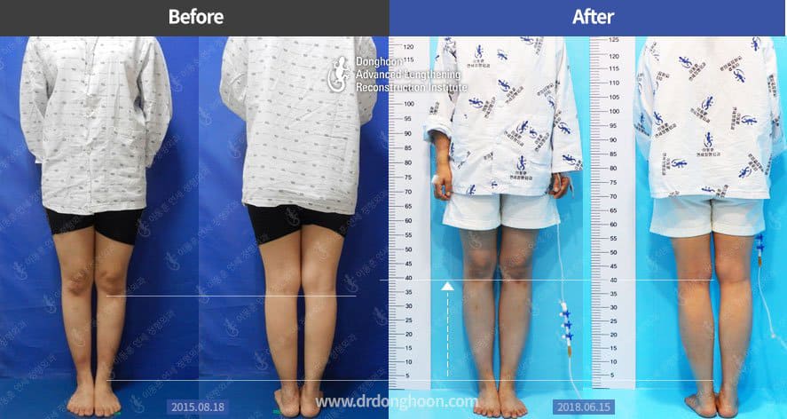 속성연장 7cm
